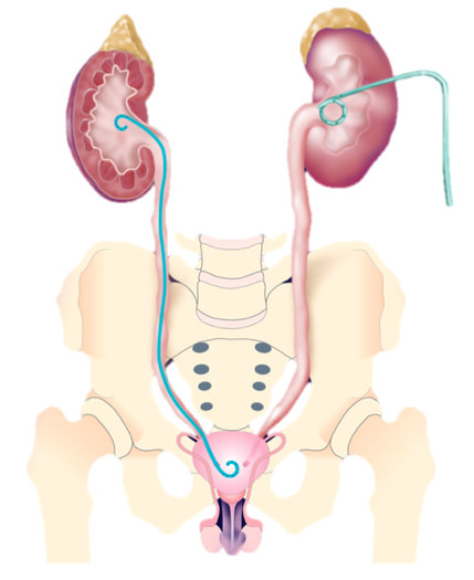 Estenose de Ureter Imagem 1