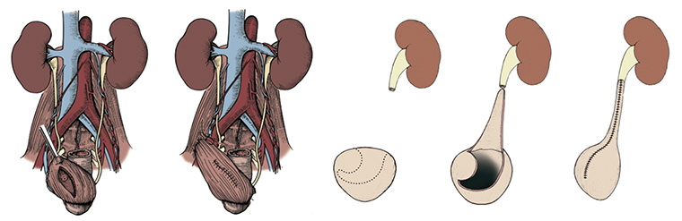 Estenose de Ureter Imagem 2