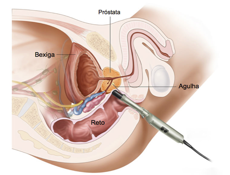 Biópsia de Próstata Imagem 1